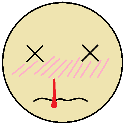 penyebab-mimisan