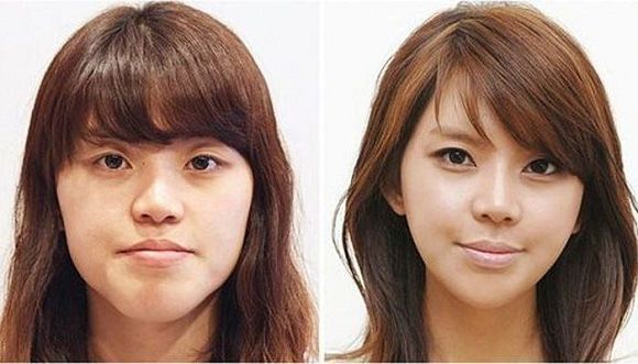 foto operasi plastik korea 1