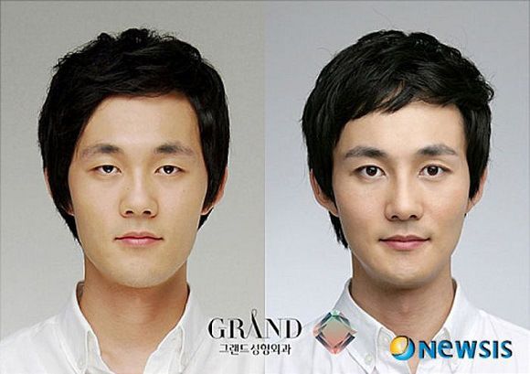 Foto operasi plastik korea 10