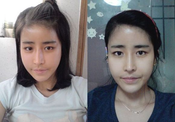 foto operasi plastik korea 11