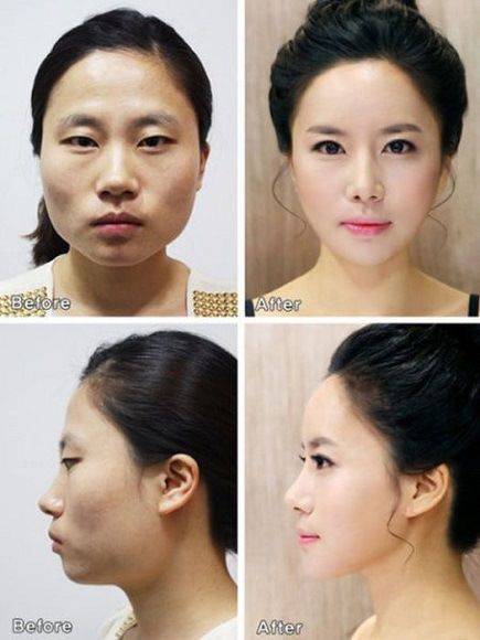 foto-operasi-plastik-korea-12