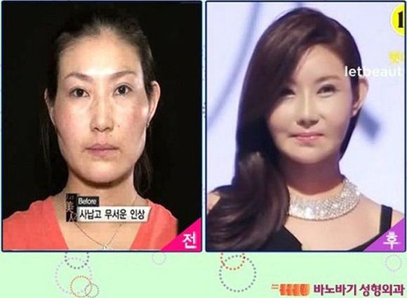 foto-operasi-plastik-korea-13
