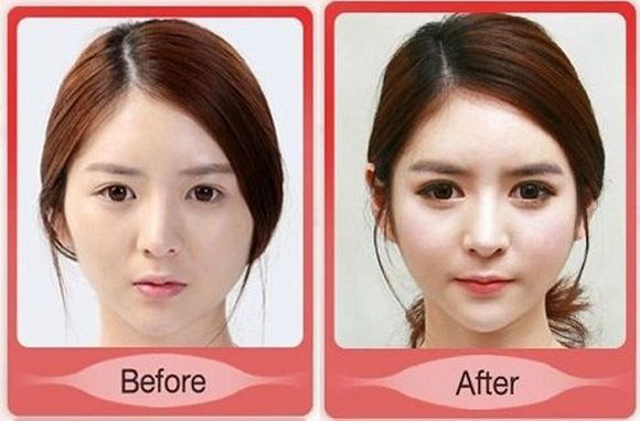 foto-operasi-plastik-korea-14