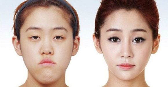 foto-operasi-plastik-korea-15