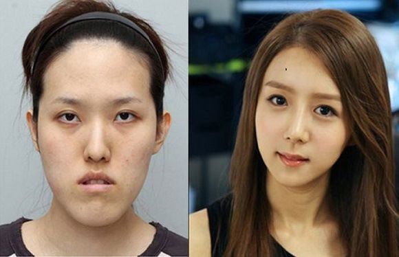 foto-operasi-plastik-korea-16