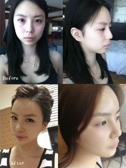 foto-operasi-plastik-korea-17