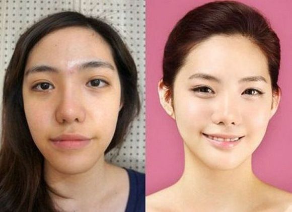 foto-operasi-plastik-korea-18