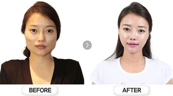 foto-operasi-plastik-korea-19