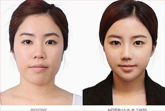 Foto operasi plastik korea 2