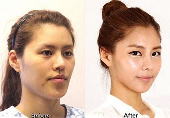 foto-operasi-plastik-korea-20