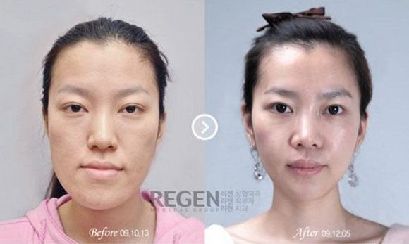 foto-operasi-plastik-korea-21
