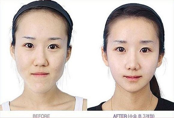 foto-operasi-plastik-korea-22