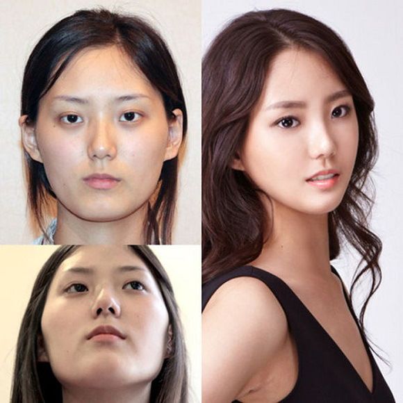 foto-operasi-plastik-korea-23