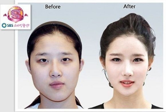foto-operasi-plastik-korea-24