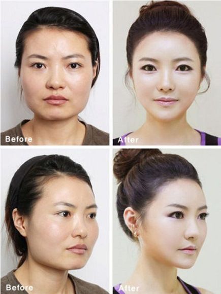 foto-operasi-plastik-korea-25