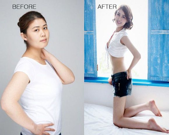 foto-operasi-plastik-korea-26