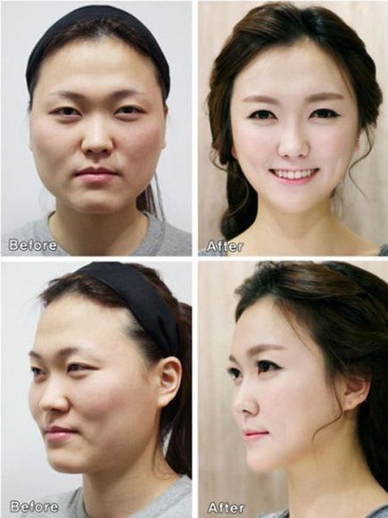 foto-operasi-plastik-korea-27