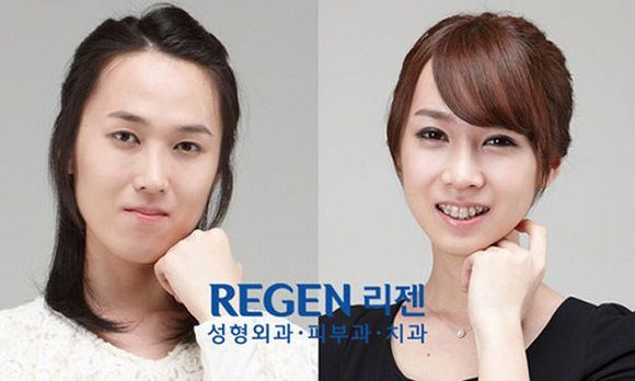 foto-operasi-plastik-korea-28