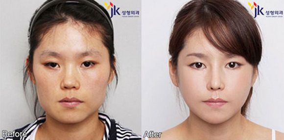 Foto operasi plastik korea 3