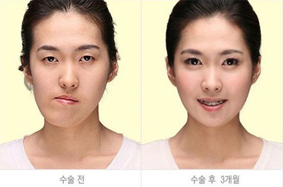 foto-operasi-plastik-korea-31