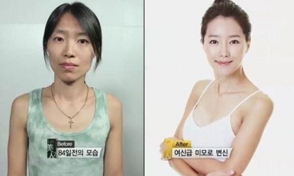 foto-operasi-plastik-korea-32
