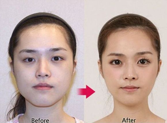 foto-operasi-plastik-korea-35