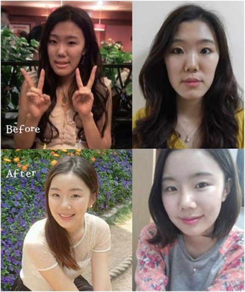 foto-operasi-plastik-korea-36