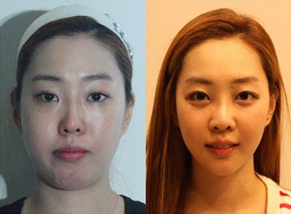 foto-operasi-plastik-korea-38
