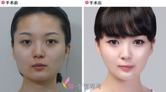 foto-operasi-plastik-korea-40