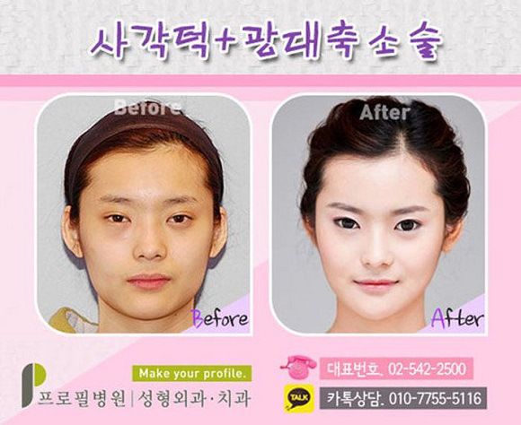 foto-operasi-plastik-korea-41