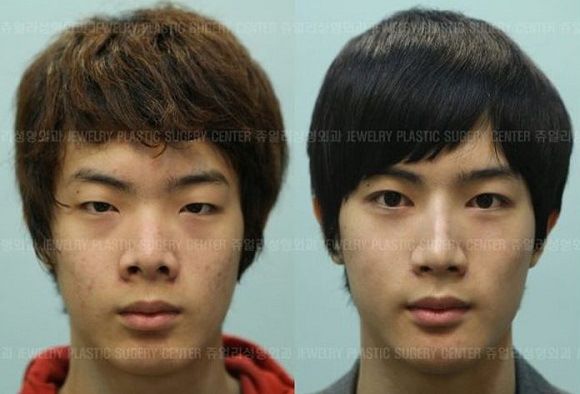 foto-operasi-plastik-korea-42