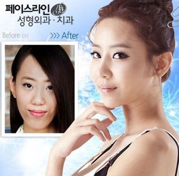 foto-operasi-plastik-korea-43