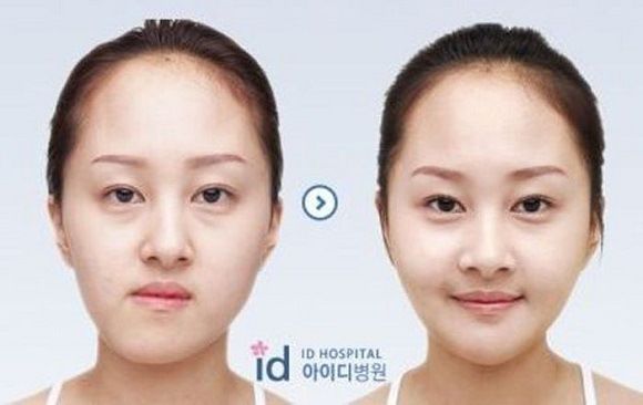 foto-operasi-plastik-korea-44