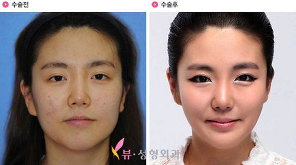foto-operasi-plastik-korea-45