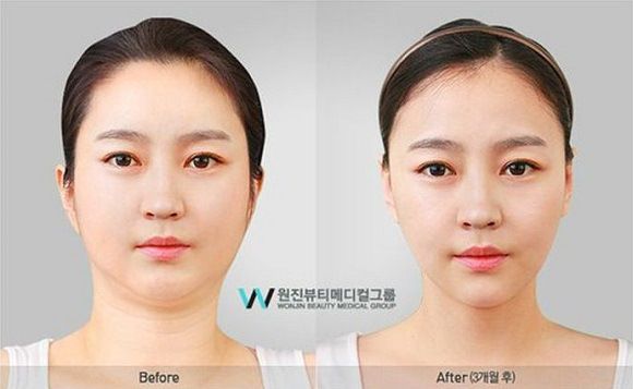 foto-operasi-plastik-korea-46