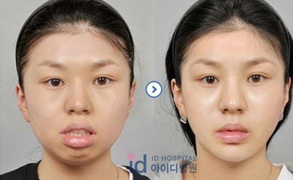 foto-operasi-plastik-korea-47