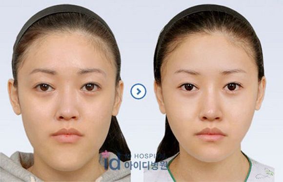 foto-operasi-plastik-korea-48