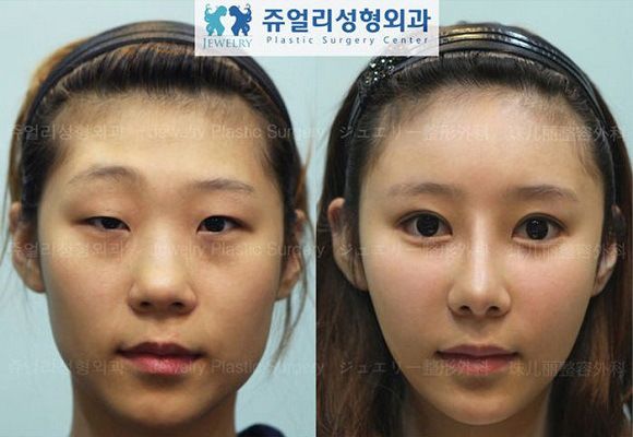 foto-operasi-plastik-korea-49
