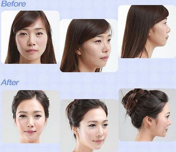 foto-operasi-plastik-korea-50