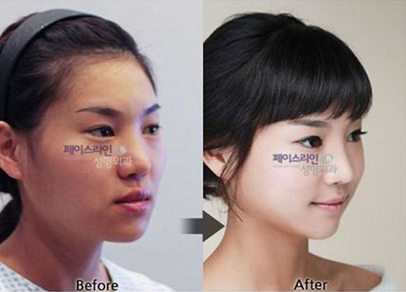 foto-operasi-plastik-korea-51