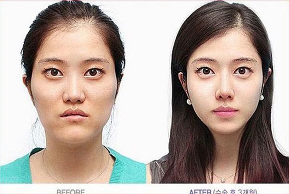 foto-operasi-plastik-korea-52