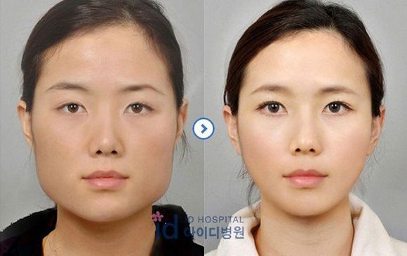 foto-operasi-plastik-korea-53