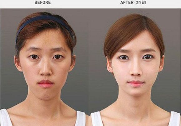 foto-operasi-plastik-korea-54