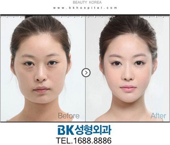 foto-operasi-plastik-korea-55