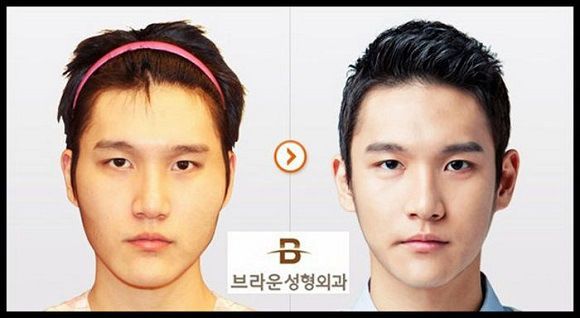 foto-operasi-plastik-korea-56
