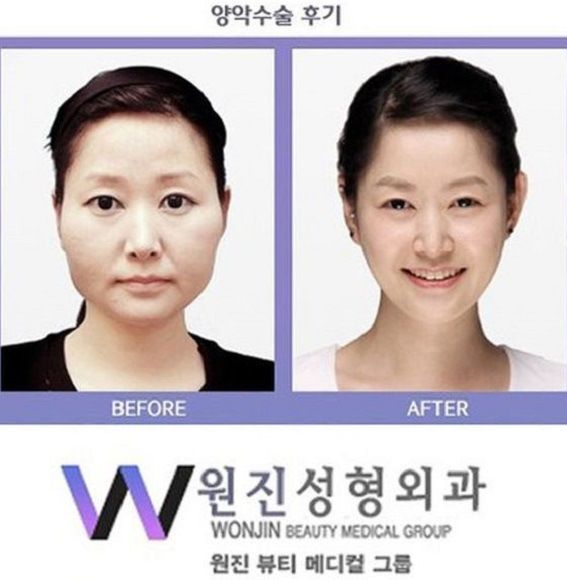 foto-operasi-plastik-korea-57
