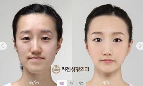 foto-operasi-plastik-korea-58