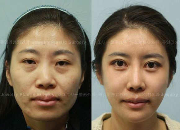 foto-operasi-plastik-korea-59