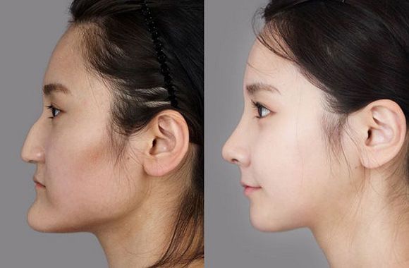Foto operasi plastik korea 6