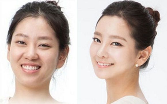 foto-operasi-plastik-korea-60-0